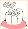 写真：歯の一部分にセラミックを詰める方法