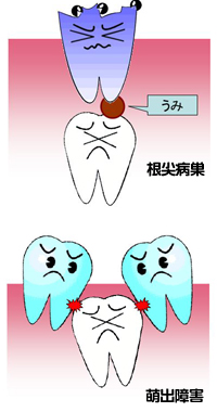 写真：乳歯の虫歯は必ず治療しないといけないの？